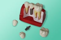 Übergroßes Modell von Zähnen und Implantaten zur Demonstration des Patienten 40-0001